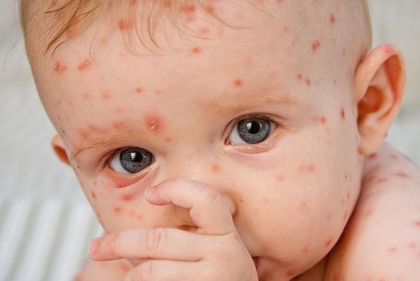 ابتلای کودکان به آبله مرغان خطرناک نیست