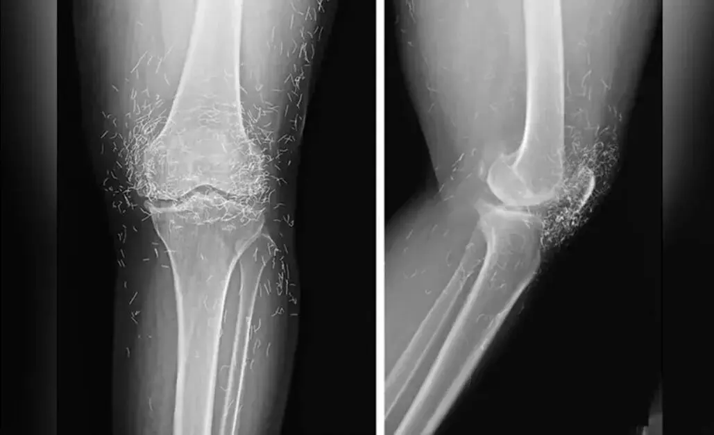 کشف صدها رشته طلای خالص در زانوی زن مبتلا به آرتروز کشف صدها رشته طلای خالص در زانوی زن مبتلا به آرتروز
