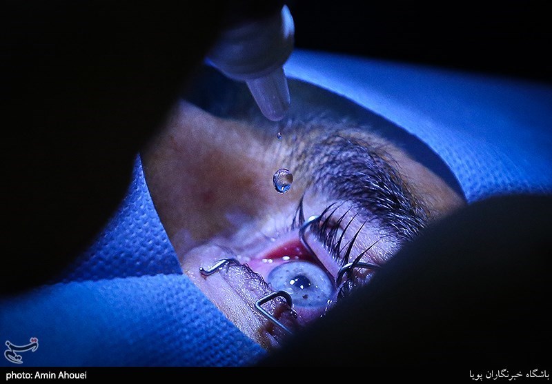 آب مروارید، شایع‌ترین علت نابینایی/کدام بیماری‌های چشم باعث نابینایی می‌شوند؟ – تسنیم