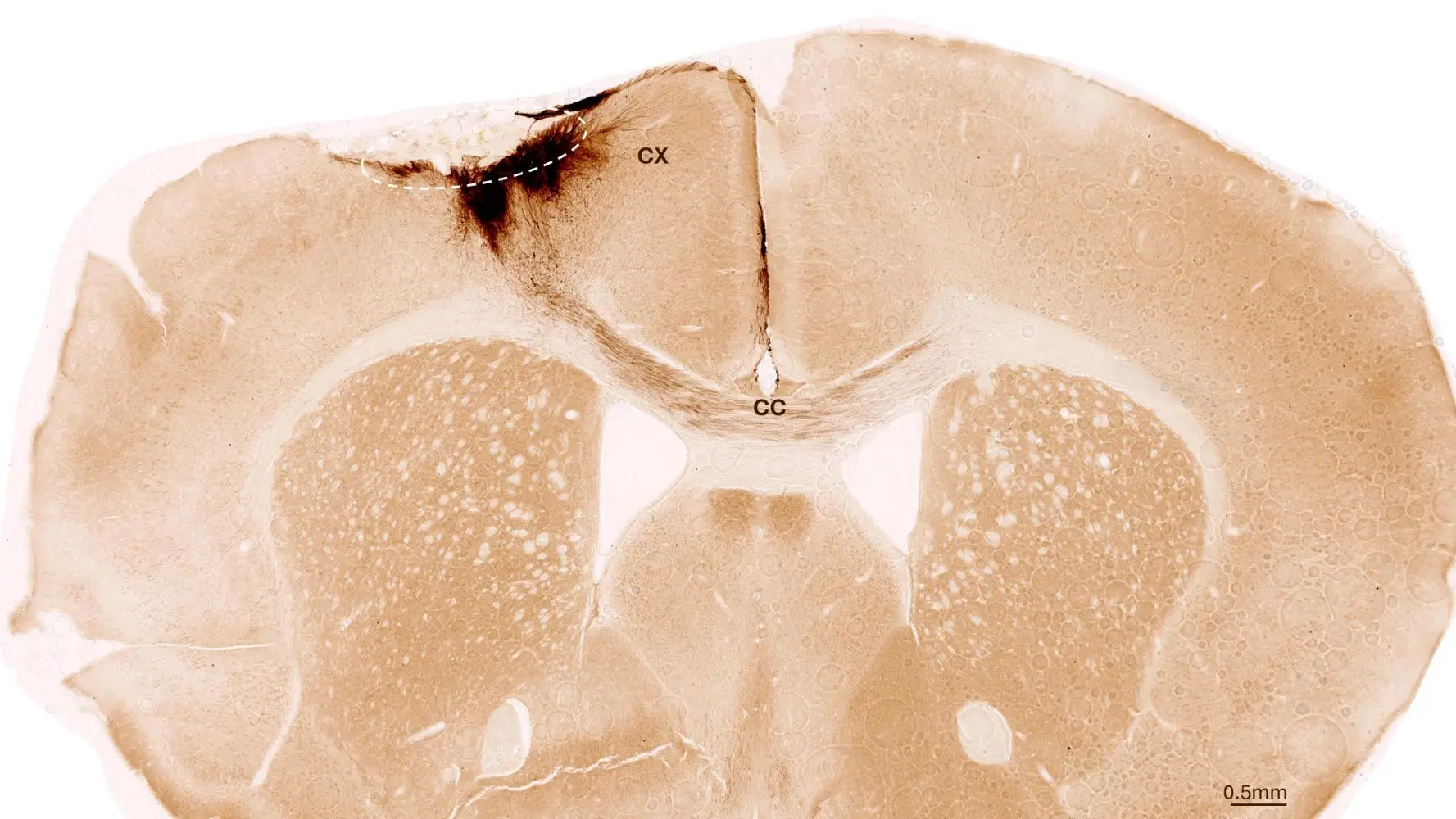 آینده درمان سکته مغزی آغاز شد؛ بازسازی مغز با فناوری زیستی