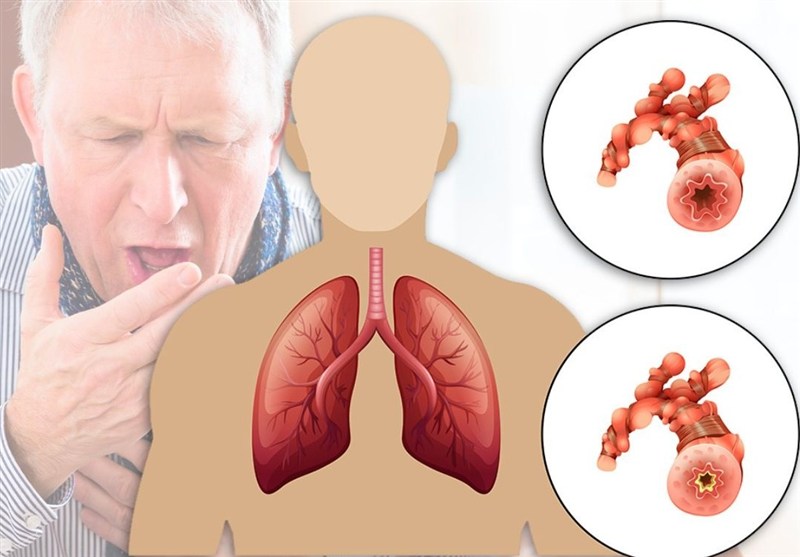 ابتلای 10 میلیون ایرانی به آسم و انسداد ریوی/ غلظت آلاینده‌های هوای تهران 30 برابر حد مجاز – تسنیم