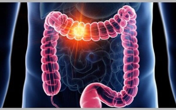 ۴ علامت اولیه سرطان روده بزرگ ۴ علامت اولیه سرطان روده بزرگ